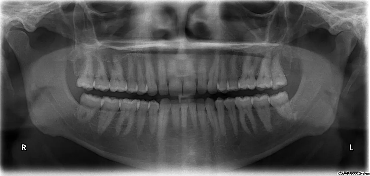 panoramic X-ray of another adult with 32 teeth; contextual illustration of a typical full adult set, not Kumar’s X-ray. Ruhrfisch, Wikimedia Commons, https://commons.wikimedia.org/wiki/File:X-ray_of_all_32_human_teeth.jpg, CC BY-SA 4.0 (https://creativecommons.org/licenses/by-sa/4.0/). Attribution: Ruhrfisch, “X-ray of all 32 human teeth,” CC BY-SA 4.0, via Wikimedia Commons. Downloaded resized variant (`?width=1200`); checked 2026-10-18.
