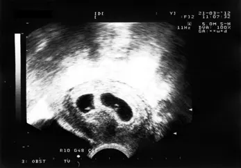 Ultrasound showing dichorionic diamniotic twins in the fourth week after fertilization; illustrative, not from the reported Colombian case. [Wikimedia Commons file](https://commons.wikimedia.org/wiki/File:Dichorionic_diamniotic_twins.jpg), Entropy1963, own work, 24 March 2012, CC BY-SA 3.0. Credit the creator, link the license, indicate changes, and share adaptations under the same or compatible license.