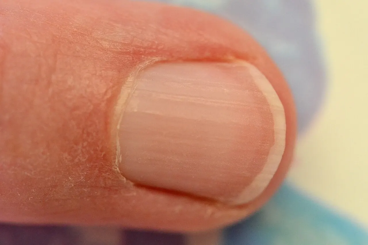 contextual close-up of another person’s left little-finger nail; not Williams. Original page: https://commons.wikimedia.org/wiki/File:Ongle_du_doigt_de_la_main_-_Fingernail_hand.jpg. Creator Bierenard. CC BY-SA 4.0 (https://creativecommons.org/licenses/by-sa/4.0/). Attribution: Bierenard, “Ongle du doigt de la main - Fingernail hand,” CC BY-SA 4.0, via Wikimedia Commons.
