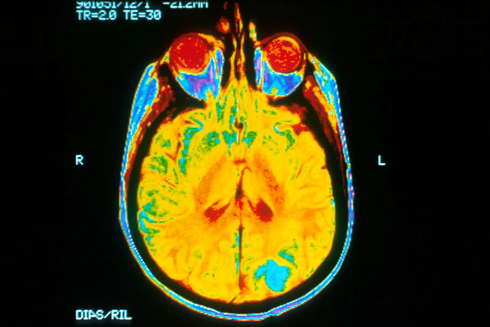 Документальне MRI-зображення головного мозку / documentary brain MRI image. Original page: https://commons.wikimedia.org/wiki/File:Brain_MRI.jpg. Source: Dr. Leon Kaufman, UCSF; released by the U.S. National Cancer Institute; photographer not identified. Public domain as a U.S. federal government image; credit NCI / UCSF. No edits. Modern/contextual result, not a 1977 scan.
